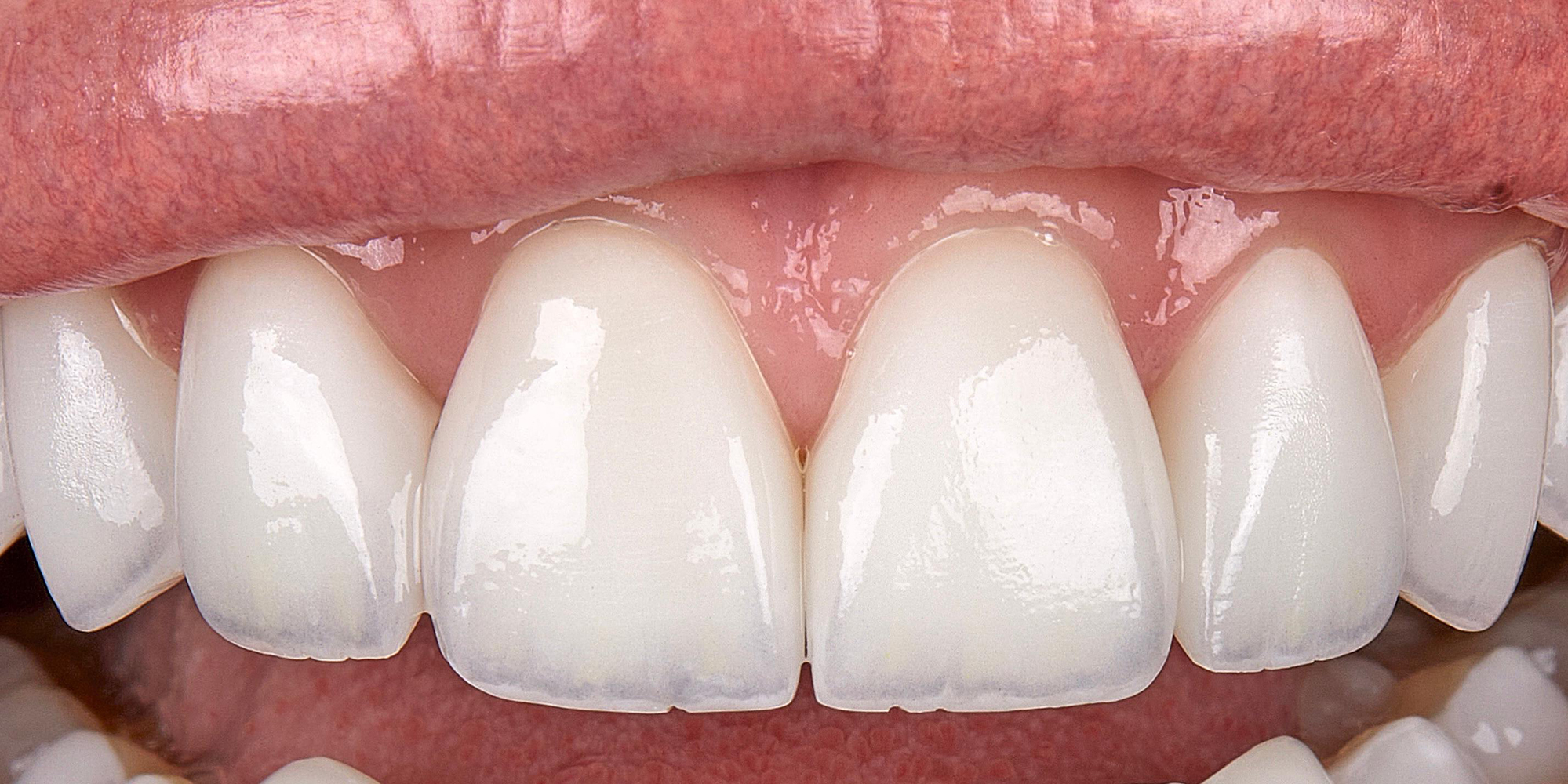 Laminas de Ceramica3